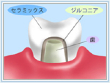 ジルコニア