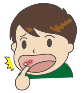 口内炎のイメージ。口内炎ができた男性が痛そうにしているところ