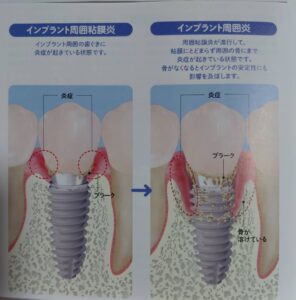 インプラント周囲炎のイメージ。切り取り写真