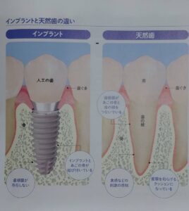 インプラントの構造