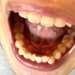 お口のお話|３月号vol.２下あごの内側にできるコブ「骨隆起」について/むし歯になりやすい「食べ方」とは