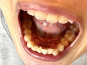 骨隆起のある女性の口腔内