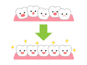 不揃いの歯が美しく整っていく様子